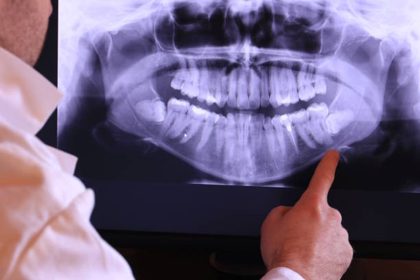 Best Emergency Treatment for Dental Infections or Abscesses in Lake Pocotopaug, CT