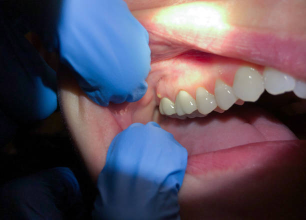 Best Emergency Tooth Extraction in Lake Pocotopaug, CT