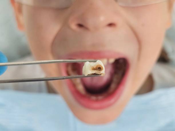 Best Emergency Tooth Extraction in Lake Pocotopaug, CT